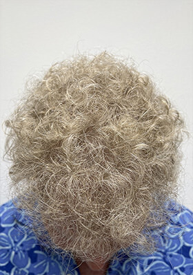 hair transplant photos