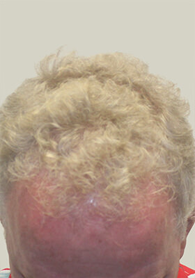 hair transplant photos