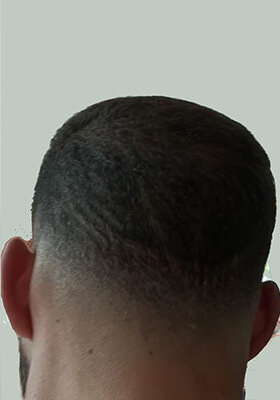 hair transplant photos