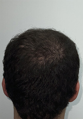 hair transplant photos