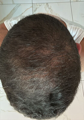 hair transplant photos