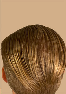 hair transplant photos