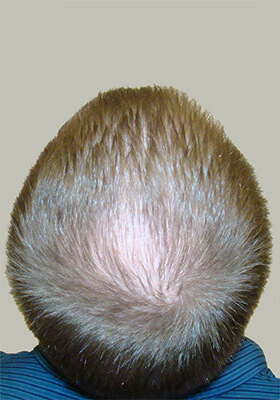 hair transplant photos