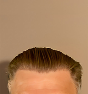 hair transplant photos