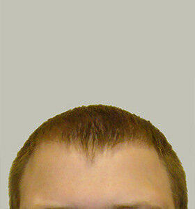 hair transplant photos