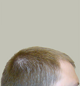 hair transplant photos