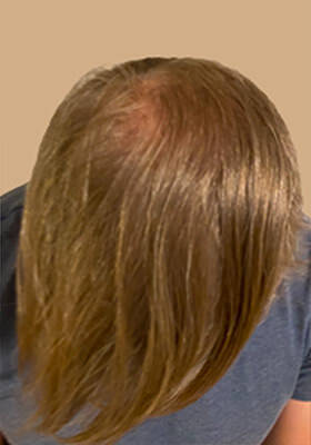 hair transplant photos