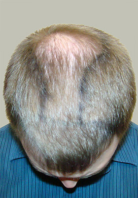 hair transplant photos