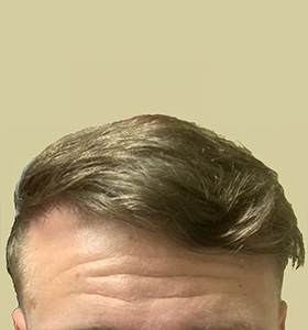 hair transplant photos