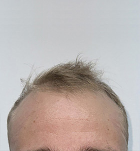 hair transplant photos