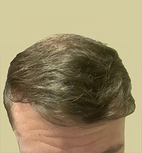 hair transplant photos