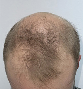 hair transplant photos