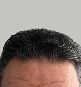 hair transplant photos