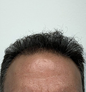 hair transplant photos