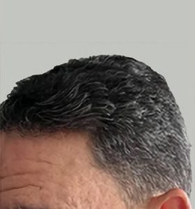 hair transplant photos
