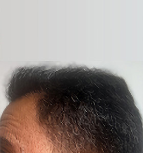 hair transplant photos