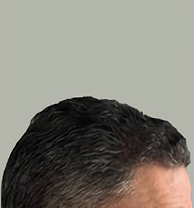 hair transplant photos