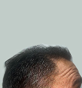 hair transplant photos