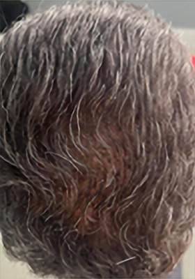 hair transplant photos