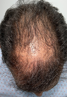 hair transplant photos