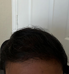 hair transplant photos