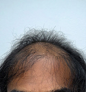 hair transplant photos