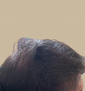 hair transplant photos