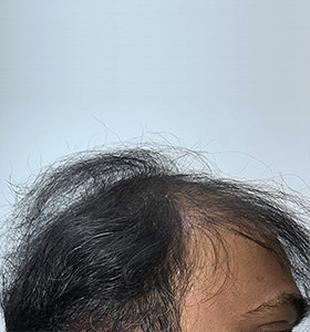 hair transplant photos