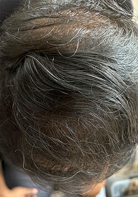 hair transplant photos
