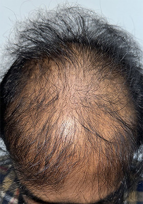 hair transplant photos