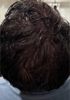 hair transplant photos