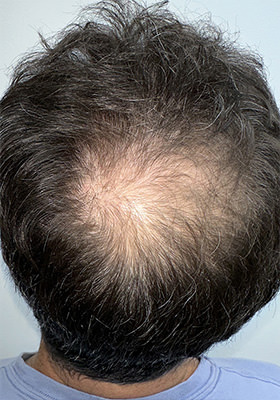 hair transplant photos