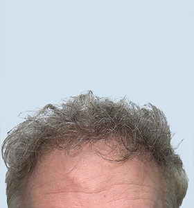 hair transplant photos