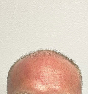 hair transplant photos