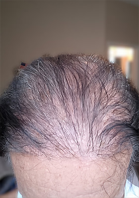 hair transplant photos
