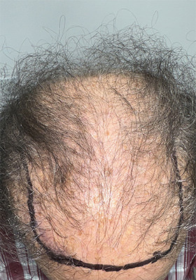 hair transplant photos