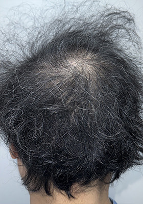 hair transplant photos