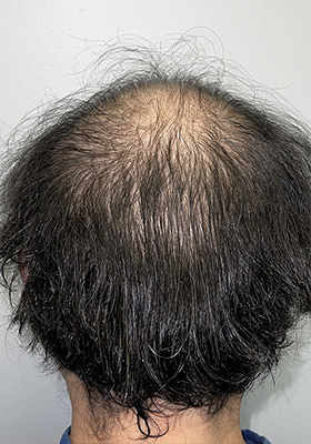 hair transplant photos