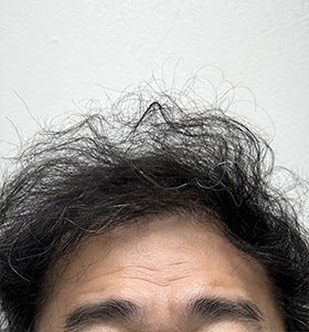 hair transplant photos