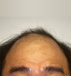 hair transplant photos