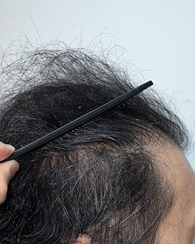 hair transplant photos