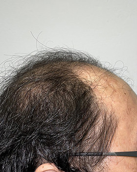 hair transplant photos