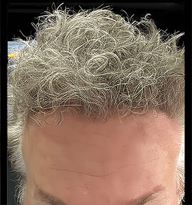 hair transplant photos
