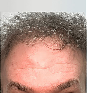hair transplant photos