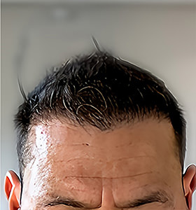hair transplant photos