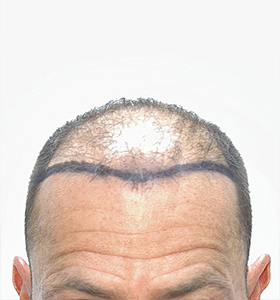 hair transplant photos