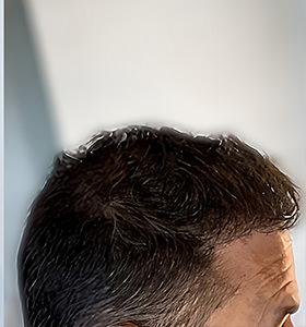 hair transplant photos