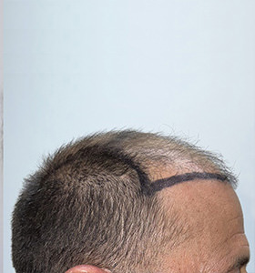 hair transplant photos