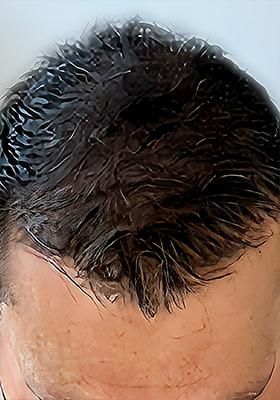 hair transplant photos