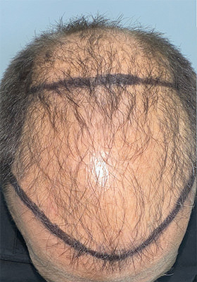 hair transplant photos